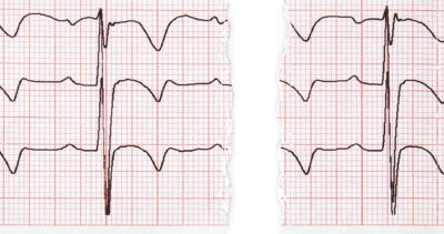 A medical chart similar to an EKG drawn on graph paper and torn in half