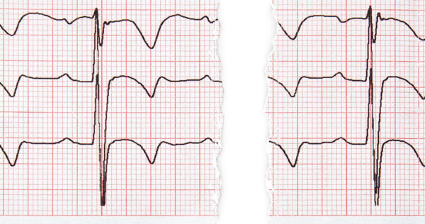 A medical chart similar to an EKG drawn on graph paper and torn in half