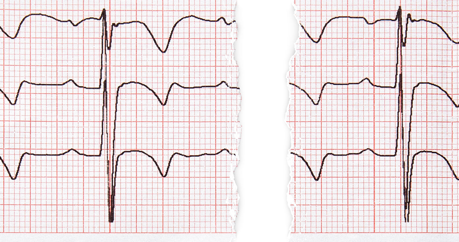 A medical chart similar to an EKG drawn on graph paper and torn in half